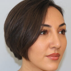 Rhinoplasty before and after - after