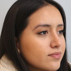 Rhinoplasty before and after - after