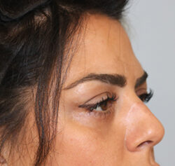Blepharoplasty before and after - after