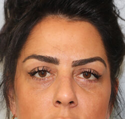 Blepharoplasty before and after - after