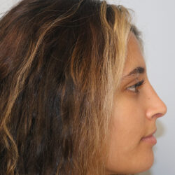 Rhinoplasty before and after - after