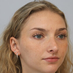 Rhinoplasty before and after - after