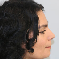 Rhinoplasty before and after - after