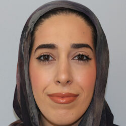Rhinoplasty before and after - after
