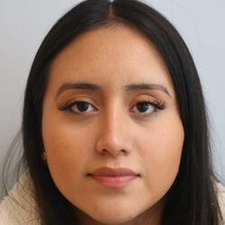 Rhinoplasty before and after - after