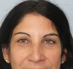 Blepharoplasty before and after - after