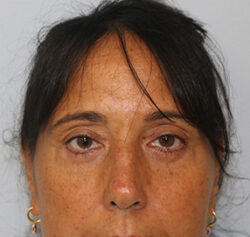 Blepharoplasty before and after - after