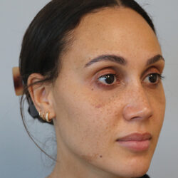Rhinoplasty before and after - after