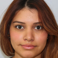Rhinoplasty before and after - after