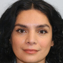 Rhinoplasty before and after - after