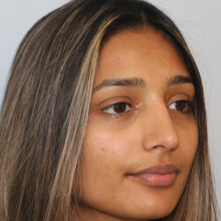 Rhinoplasty before and after - after
