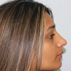 Rhinoplasty before and after - after