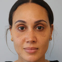Rhinoplasty before and after - after