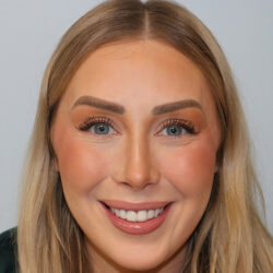 Rhinoplasty before and after - after
