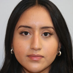 Rhinoplasty before and after - before