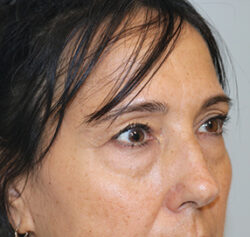 Blepharoplasty before and after - before