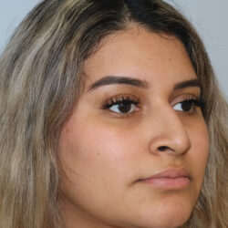 Rhinoplasty before and after - before