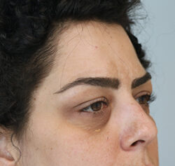 Blepharoplasty before and after - before