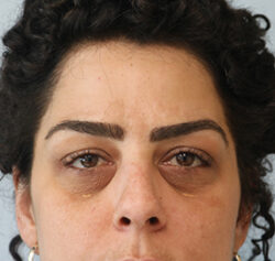 Blepharoplasty before and after - before