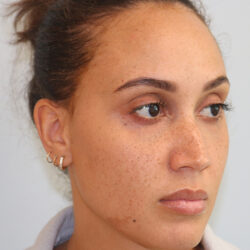 Rhinoplasty before and after - before