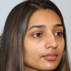 Rhinoplasty before and after - before