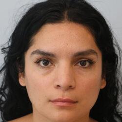 Rhinoplasty before and after - before