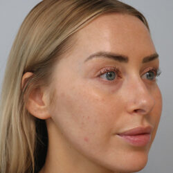 Rhinoplasty before and after - before