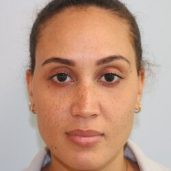 Rhinoplasty before and after - before
