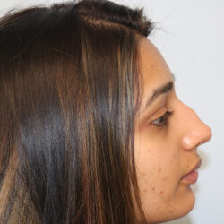 Rhinoplasty before and after - before
