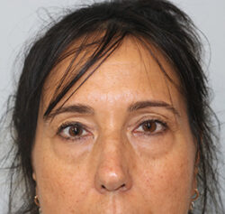 Blepharoplasty before and after - before