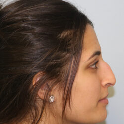 Rhinoplasty before and after - before