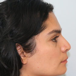 Rhinoplasty before and after - before