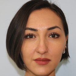 Rhinoplasty before and after - before