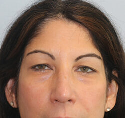 Blepharoplasty before and after - before