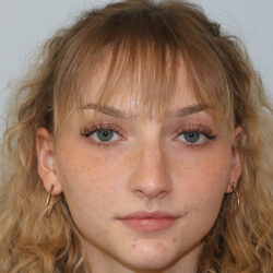 Rhinoplasty before and after - before