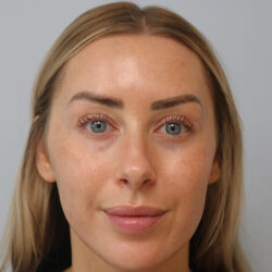 Rhinoplasty before and after - before