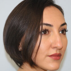 Rhinoplasty before and after - before