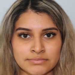 Rhinoplasty before and after - before
