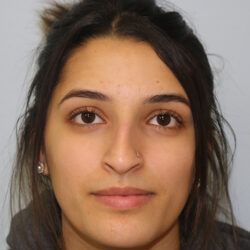 Rhinoplasty before and after - before