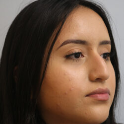 Rhinoplasty before and after - before