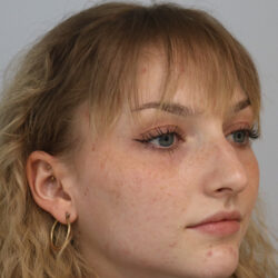 Rhinoplasty before and after - before