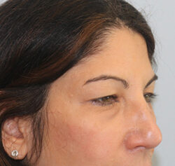 Blepharoplasty before and after - before