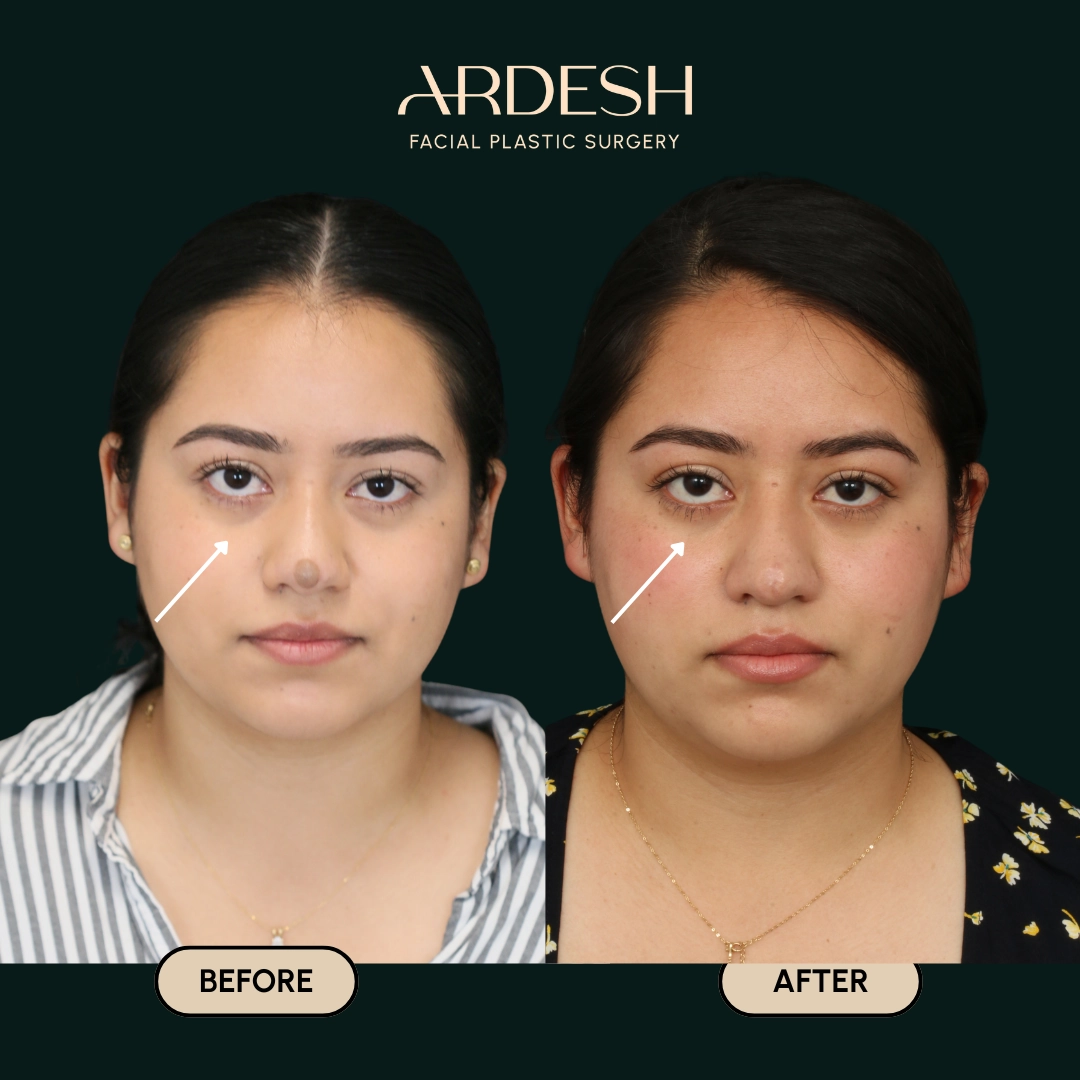 Procedure before and after - after
