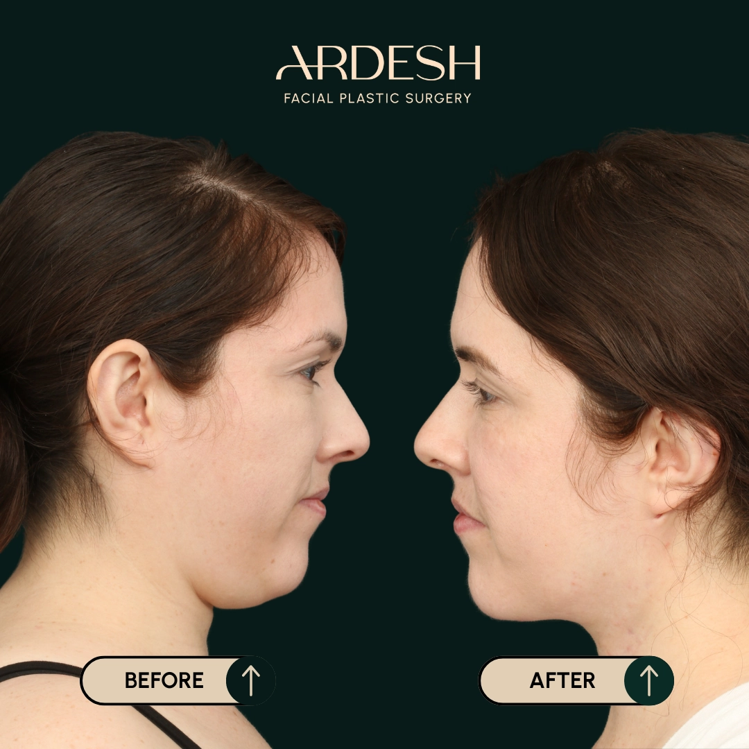 Procedure before and after - after