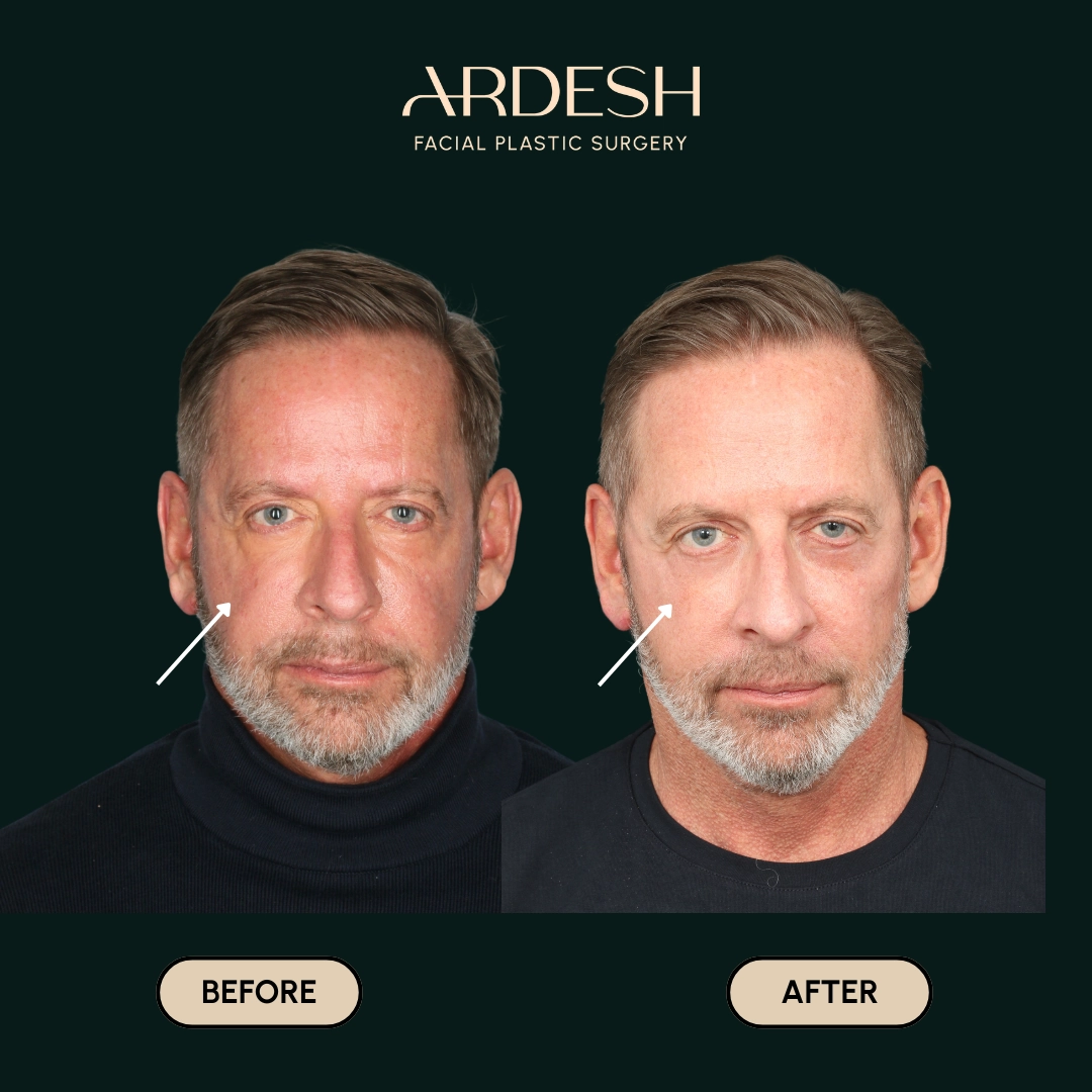 Procedure before and after - after