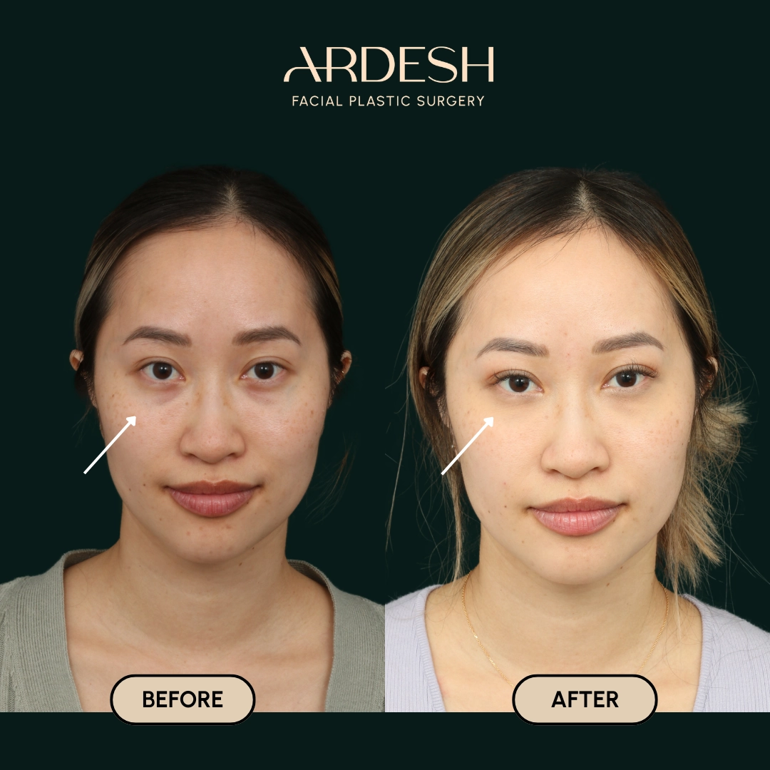 Procedure before and after - after