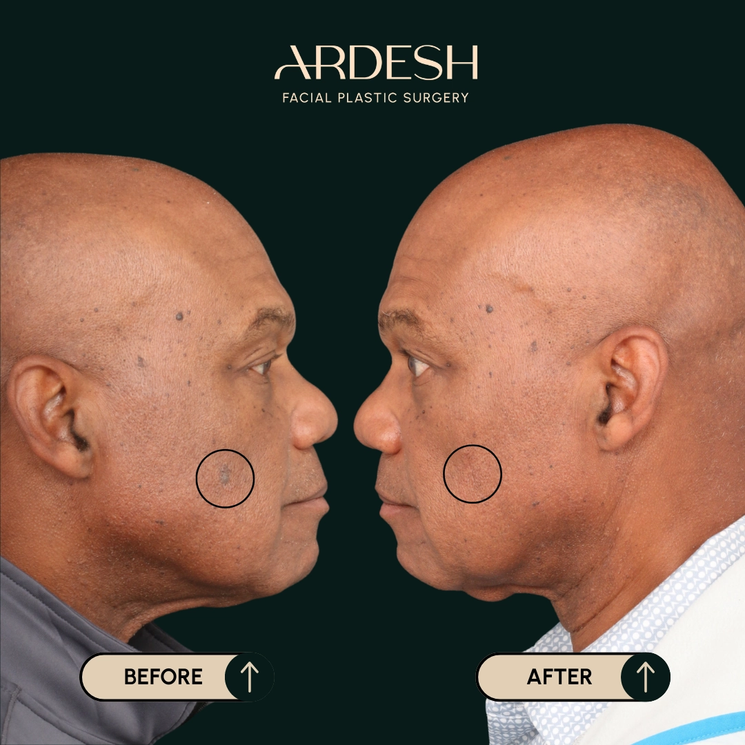 Procedure before and after - after