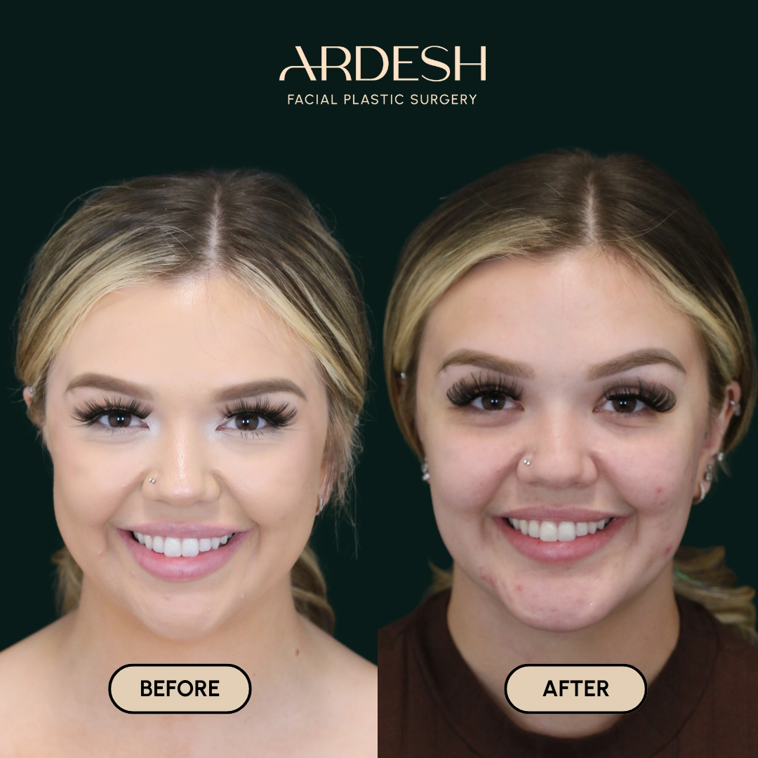 Procedure before and after - after