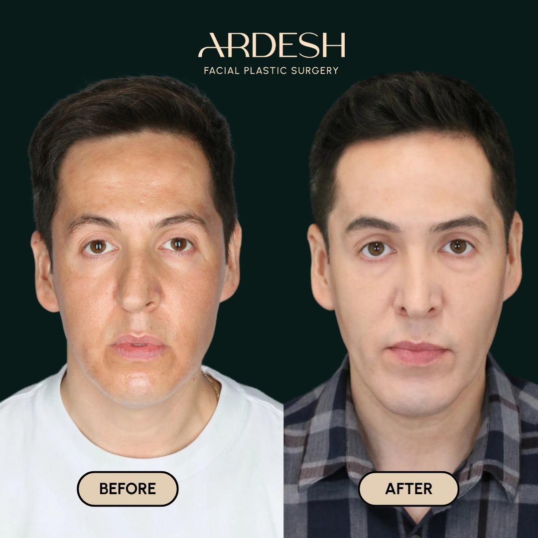 Procedure before and after - after