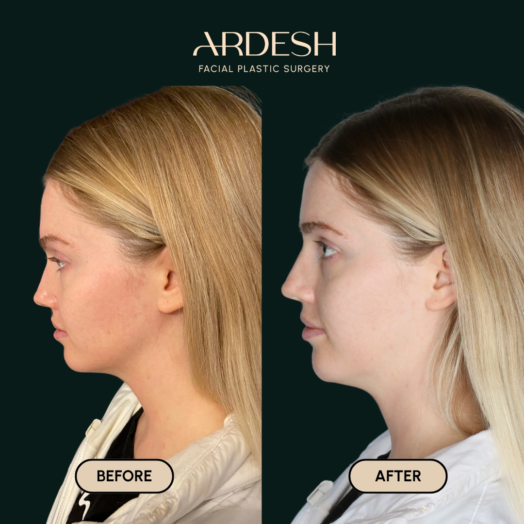 Procedure before and after - after